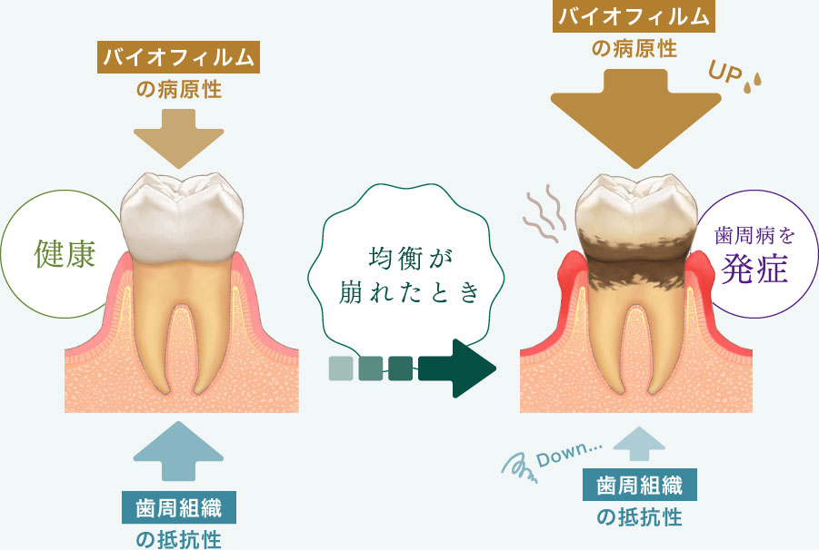 均衡が崩れたとき歯周病を発症