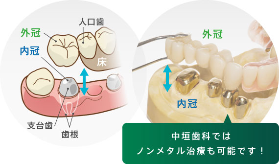 中垣歯科ではノンメタル治療が可能です！