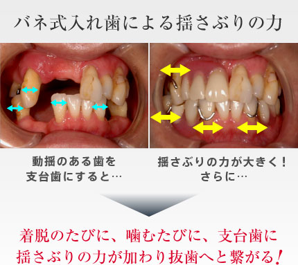 着脱のたびに、噛むたびに、支台歯に揺さぶりの力が加わり抜歯へと繋がる!