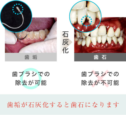 これまでの歯周病治療 大阪で歯周病治療なら 中垣歯科医院